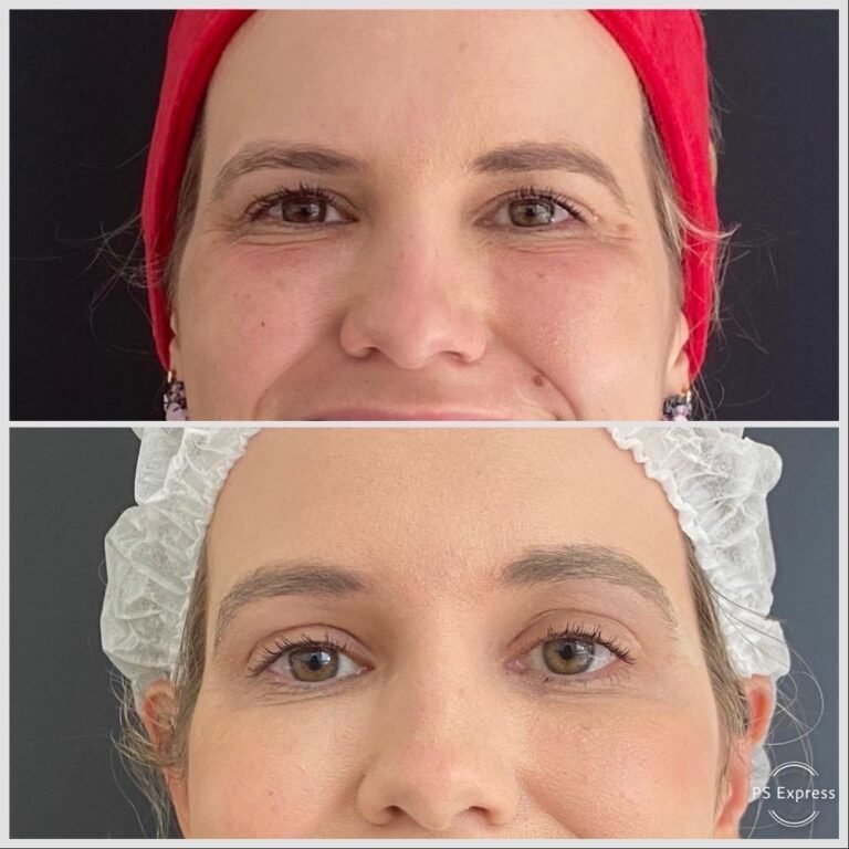 Antes e Depois do Plasma IQ