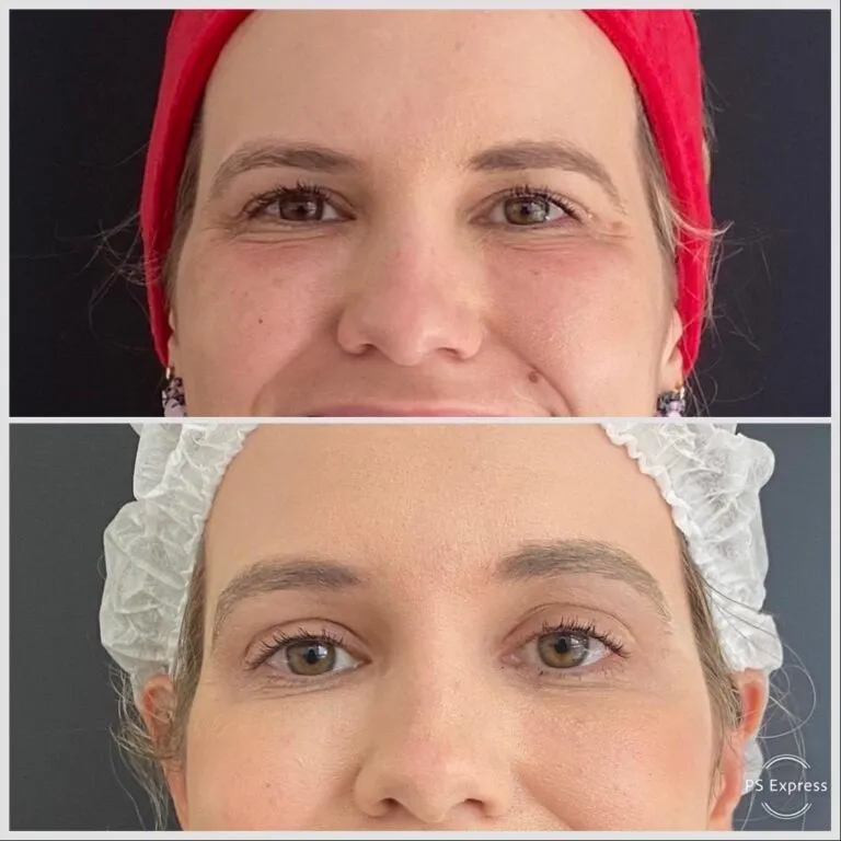 Antes e Depois do Plasma IQ